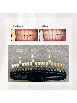 ペルレ(Perl)/5回コースビフォーアフター