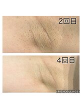 レイモード(Ray mode)/全身脱毛♪VIOあり高校生