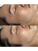 ヨルエステ(yoru aesthe)/【シミケア】