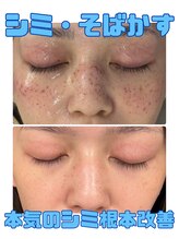 アディス 心斎橋(ADISE) 人気No.2 シミケア