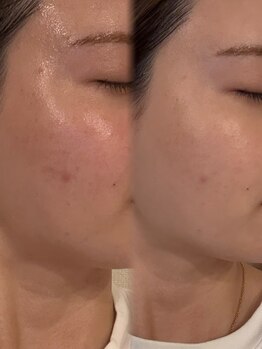 レイニゲン(H/Reinigen)/