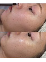 ココリール/乾燥.ニキビ