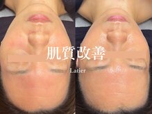 ラティエ(Latier)/継続ケア/ハーブピーリング2回目