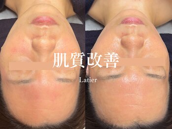 ラティエ(Latier)/継続ケア/ハーブピーリング2回目