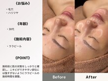 フェイシャル/ララピール/毛穴ケア/角質ケア/ピーリング/恵比寿 