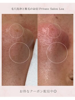 レア(Lea)/お肌のザラ付き1度で改善します