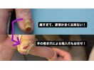 手の陥入爪の強い痛みも改善へ