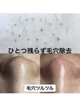 ビューティーネイル(Beauty Nail)/毛穴エクストラクション
