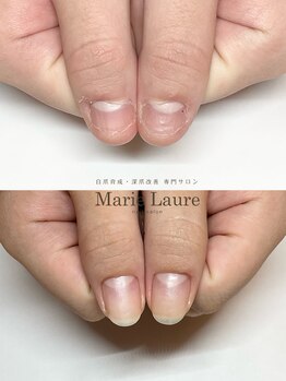 マリーロール 梅田店(Marie Laure)/自爪育成/深爪矯正/ネイルケア