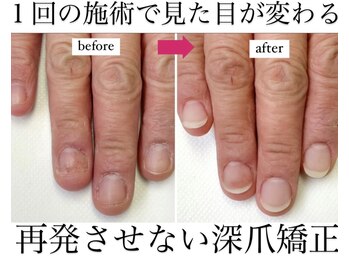 トイロ(toiro)/実績数50,000名の施術方法