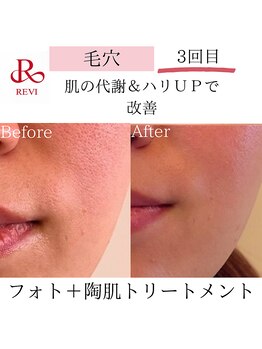 アイビー(IVY)/ハーブピーリング+光フォト