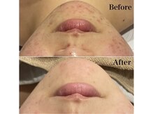 リリー 岐阜店(Lily)/プラズマ×ハーブピーリング