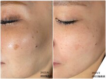 桜/最新光フェイシャル♪ビフォアフ