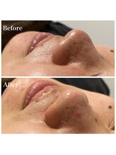 リゲルス(Regel)/角質除去・毛穴洗浄