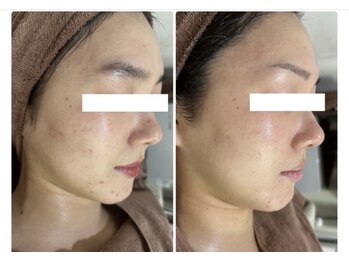 ホワイトアクア 北千住店(WHITE AQUA)/ハーブピーリング/肌質改善/毛穴