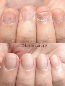 マリーロール 天王寺店(Marie Laure)/深爪矯正/自爪育成/ネイルケア
