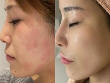 ミュー 岡崎店(mieux)/◇月に2回の施術がベスト！