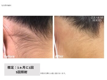 ヴィヴァーチェ(Vivace)/襟足脱毛　Before→after