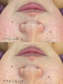 ツヤハダコガオ 千葉店/before⇒after 【ララピール】