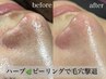 大人気【ツヤ肌ハーブピーリング】毛穴黒ずみ/開き/ニキビケア ¥10000→¥5000