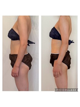 ヨサパーク ピクシス(YOSA PARK)/ヒップアップもお任せ☆