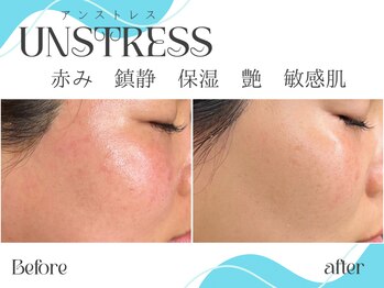 ビバディ(Vivady)/UNSTRESS