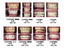 エクシアホワイト 立川南口店/プレミアムホワイトニングも人気