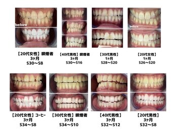 エクシアホワイト 立川南口店/プレミアムホワイトニングも人気