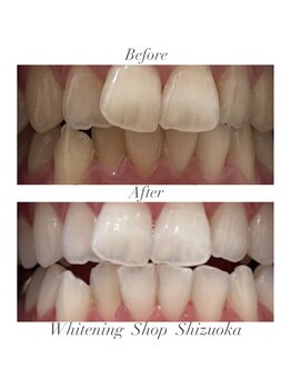 ホワイトニングショップ 静岡店/ホワイトニングBefore→After