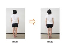 飯能ひだまり整骨院/O脚の改善