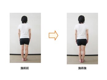 飯能ひだまり整骨院/O脚の改善