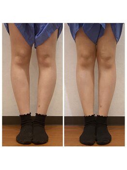 ととのえ美容整体の写真/【O脚・X脚でお悩みの方】下肢アライメントの崩れを根本から整え、まっすぐ美しい理想の脚ラインへ導きます