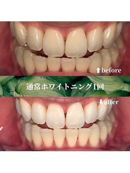 フタバ 天神大名店(futaba)/初回ホワイトニングbefore after