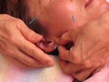 クローブ鍼灸院(CLOVE鍼灸院)/めまい・耳鳴りを改善する鍼灸