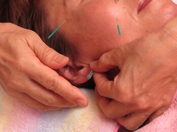 クローブ鍼灸院(CLOVE鍼灸院)/めまい・耳鳴りを改善する鍼灸