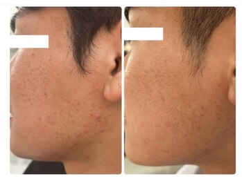 ホワイトアクア 北千住店(WHITE AQUA)/ハーブピーリング/肌質改善/毛穴