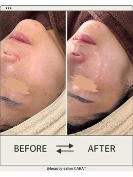 カラット(CARAT)/ララピール×ゲルマスク