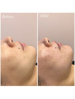 ホワイトワックス 京都四条烏丸(WHITE WAX)/《全顔》フェイシャルワックス