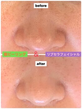 プリュネル(Prunelle)/酸ピーリング&プラズマシャワー