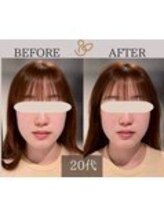 チョコバリ 錦糸町店(chocobari)/小顔×リフトアップ(美容鍼)20代