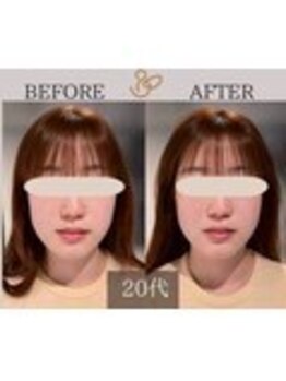 チョコバリ 錦糸町店(chocobari)/小顔×リフトアップ(美容鍼)20代