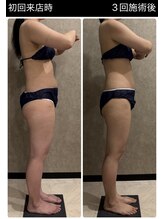 トータルビューティー ミミ(Total Beauty mimi)/太ももを集中施術