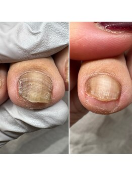 ハビッツ(habits)/変色した爪