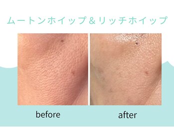 Eclanique【エクラニーク】（脱毛/毛穴/小顔/バスト/ホイップスパ）【12/20～(予定)】