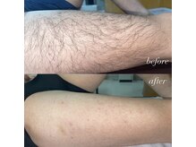 サンゴーハチ(358)/《全身脱毛》