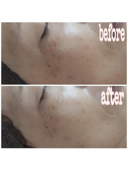 ピュルテ/スノーピールで美白・シミケア!