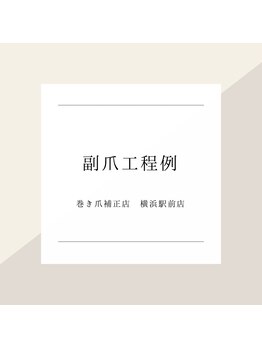 巻き爪補正店 横浜駅前店/～副爪工程例～