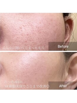 オルネ(ORNE.)/毛穴開きの改善《NK細胞美容》