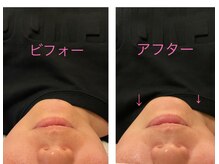 ルカシエ(Le Cacie)/30代女性/リフトアップ