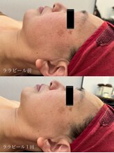 エステサロン ベリシモ(Bellissimo)/フェイシャル/ビフォーアフター